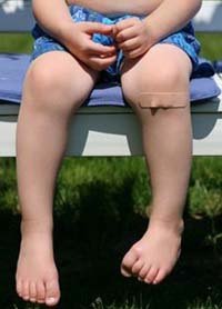 KIMS - Orthopaedic Hospital India - KIMS - Orthopaedic Hospital India