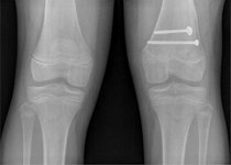 KIMS - Orthopaedic Hospital India - KIMS - Orthopaedic Hospital India