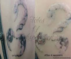 Laser Tattoo Removal Clinic Croydon & London - Laser Tattoo Removal Clinic Croydon & London