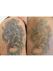 Laser Tattoo Removal Clinic Croydon & London - Laser Tattoo Removal Clinic Croydon & London