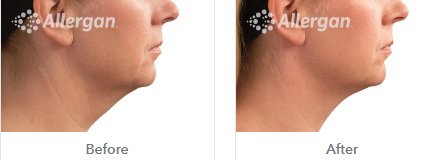 Laserderm Rynfield - Laserderm Rynfield