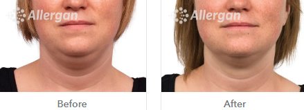 Laserderm Rynfield - Laserderm Rynfield