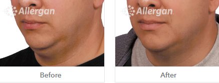 Laserderm Rynfield - Laserderm Rynfield