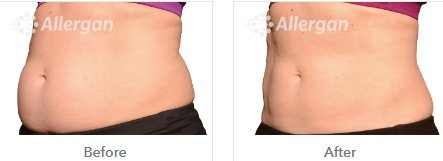 Laserderm Rynfield - Laserderm Rynfield