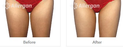 Laserderm Rynfield - Laserderm Rynfield