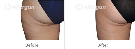 Laserderm Rynfield - Laserderm Rynfield