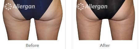 Laserderm Rynfield - Laserderm Rynfield