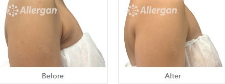 Laserderm Rynfield - Laserderm Rynfield