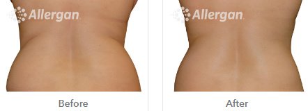 Laserderm Rynfield - Laserderm Rynfield