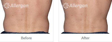 Laserderm Rynfield - Laserderm Rynfield