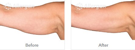 Laserderm Rynfield - Laserderm Rynfield