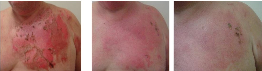 Laserderm Rynfield - Laserderm Rynfield