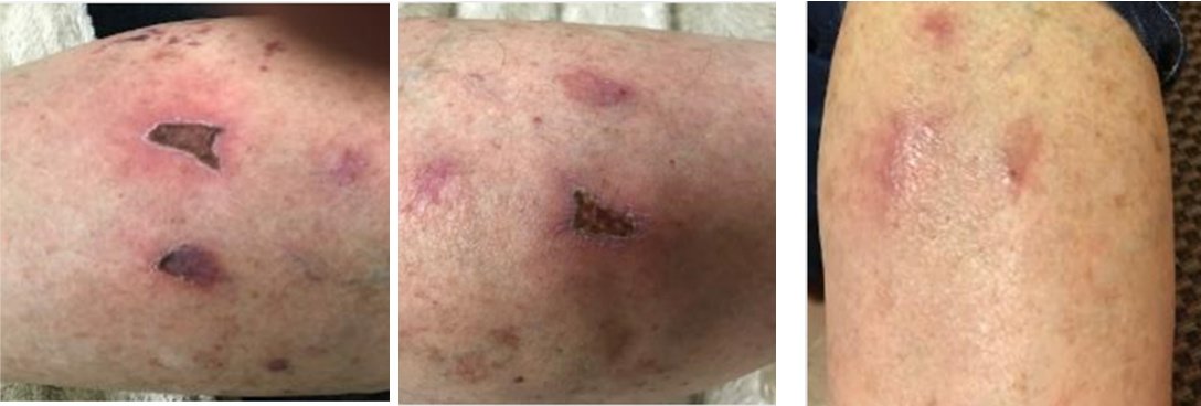 Laserderm Rynfield - Laserderm Rynfield