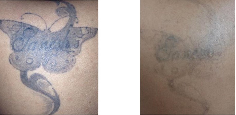 Laserderm Rynfield - Laserderm Rynfield