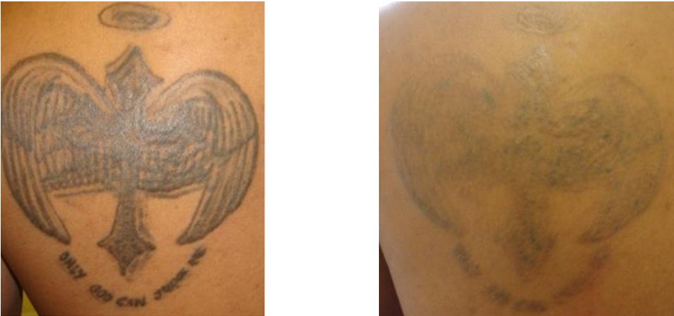 Laserderm Rynfield - Laserderm Rynfield