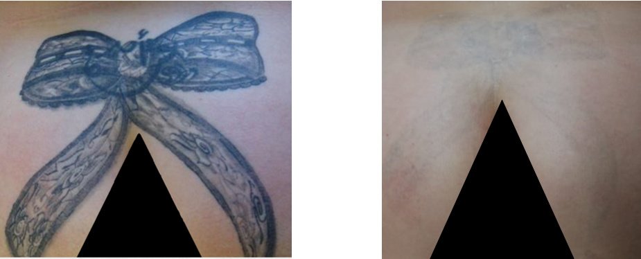 Laserderm Rynfield - Laserderm Rynfield