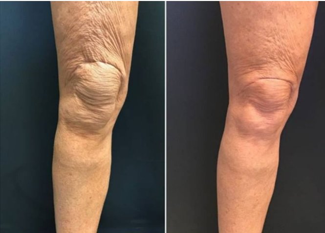 Laserderm Rynfield - Laserderm Rynfield