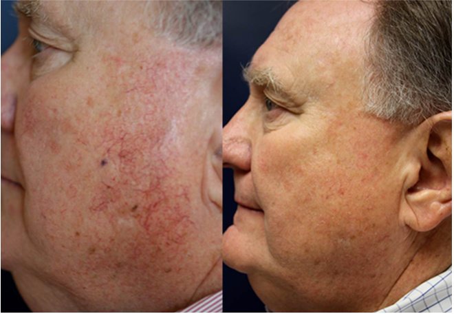 Laserderm Rynfield - Laserderm Rynfield