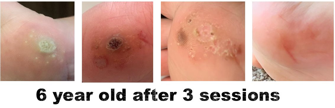 Laserderm Rynfield - Laserderm Rynfield