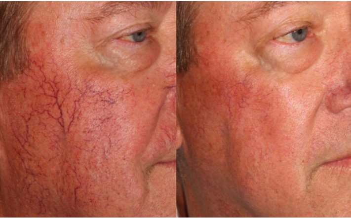 Laserderm Rynfield - Laserderm Rynfield