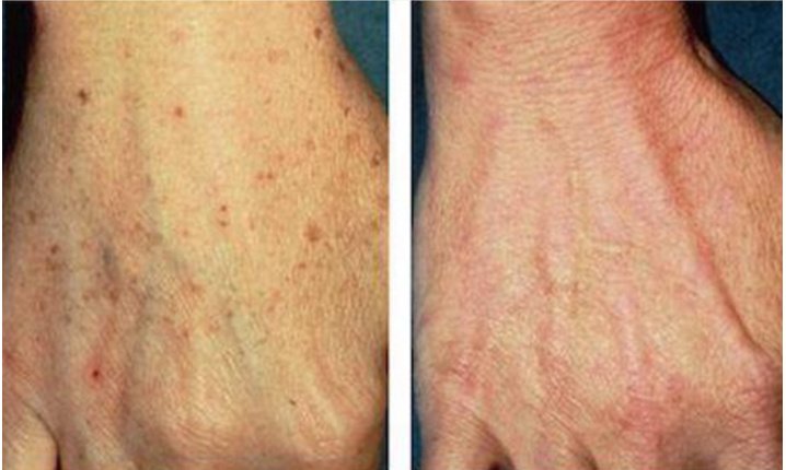 Laserderm Rynfield - Laserderm Rynfield