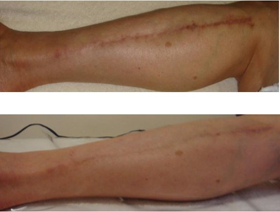 Laserderm Rynfield - Laserderm Rynfield