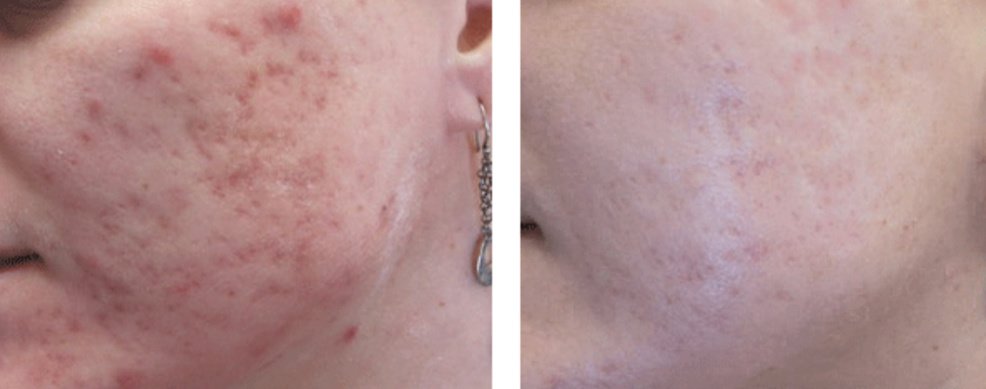 Laserderm Rynfield - Laserderm Rynfield