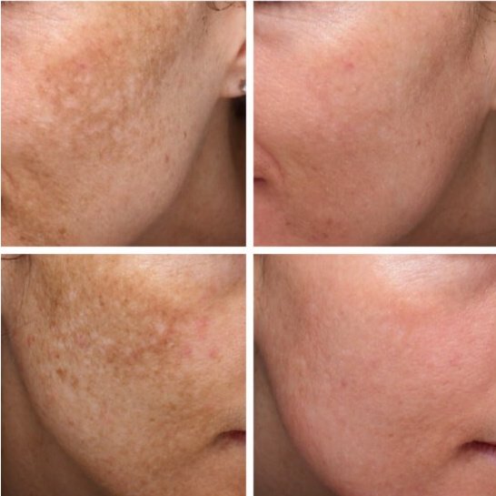 Laserderm Rynfield - Laserderm Rynfield