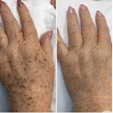 Laserderm Rynfield - Laserderm Rynfield