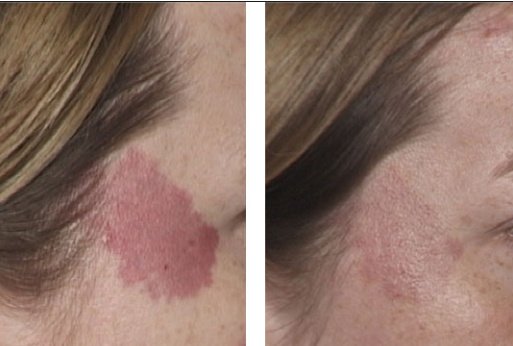 Laserderm Rynfield - Laserderm Rynfield