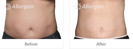 Laserderm Rynfield - Laserderm Rynfield