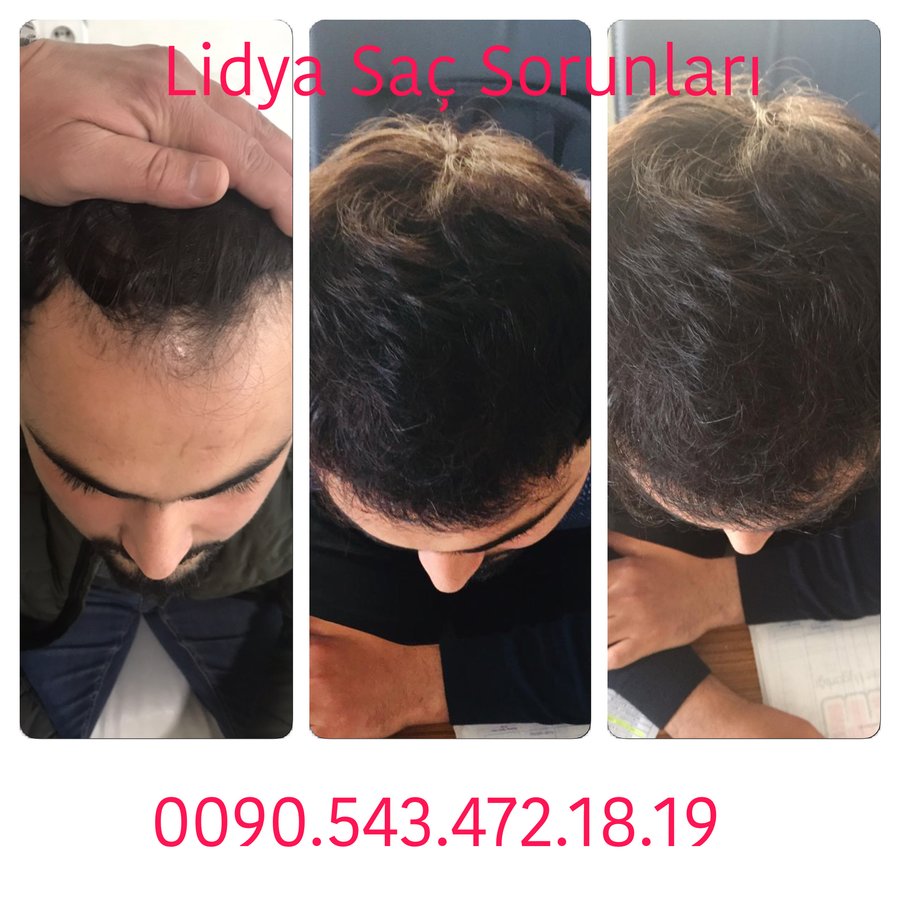 ليديا وورلد لزراعة الشعر - Lidya World Hair Transplant