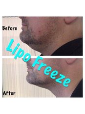 Lipo Freeze - Lipo Freeze