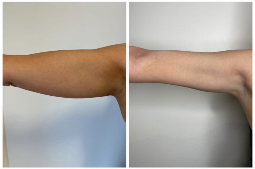 LipoShape - LipoShape