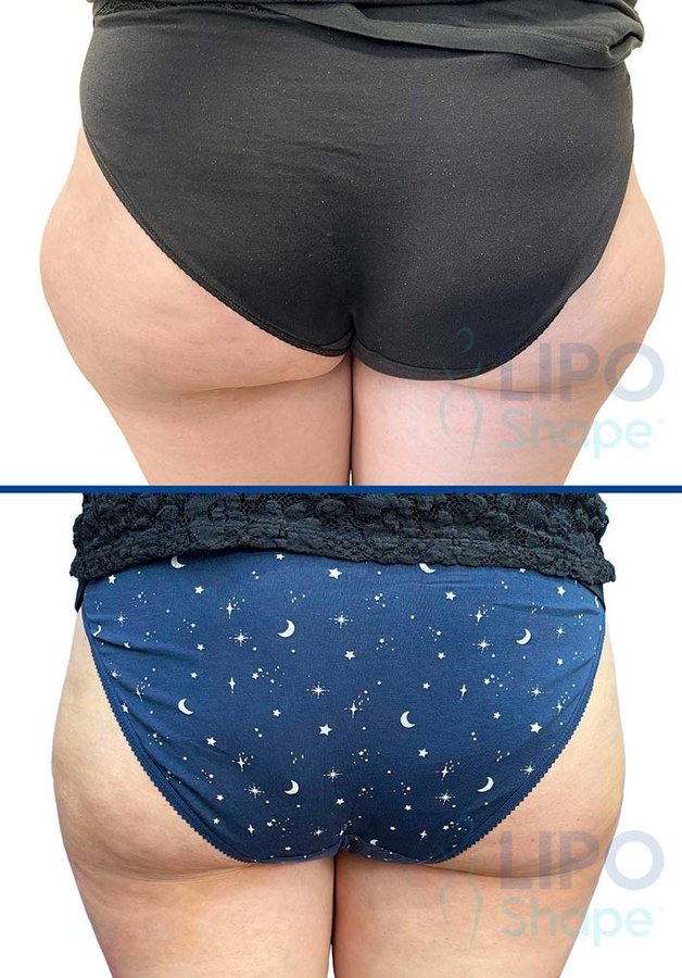 LipoShape - LipoShape