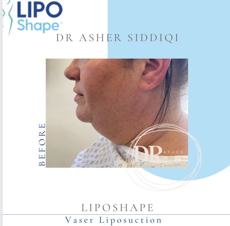LipoShape - LipoShape
