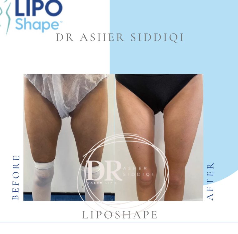 LipoShape - LipoShape