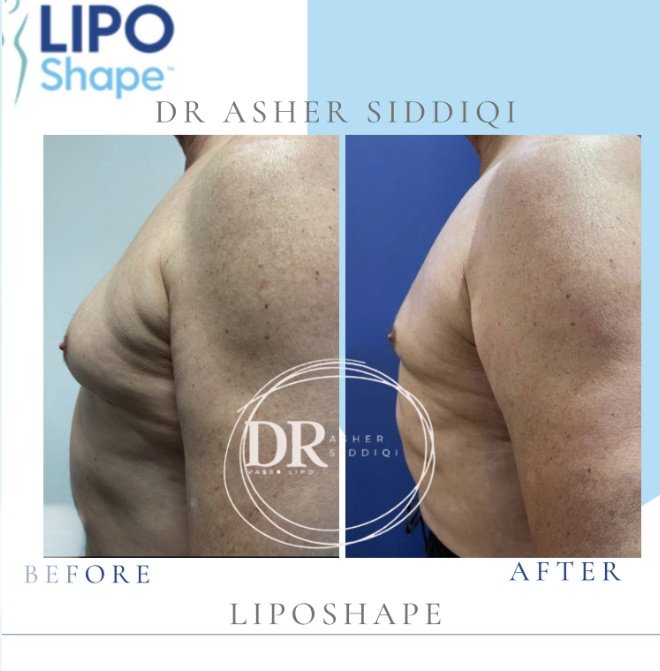 LipoShape - LipoShape