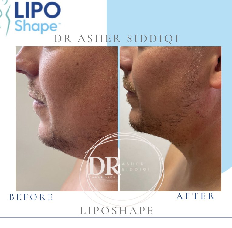 LipoShape - LipoShape