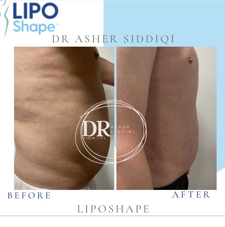 LipoShape - LipoShape