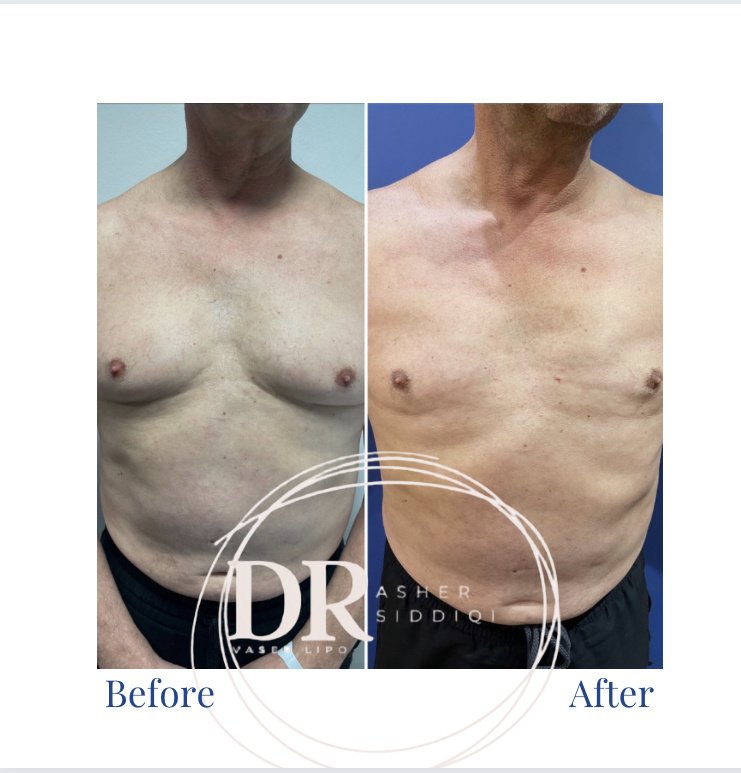 LipoShape - LipoShape