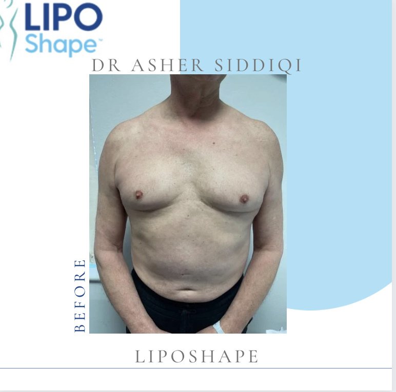 LipoShape - LipoShape