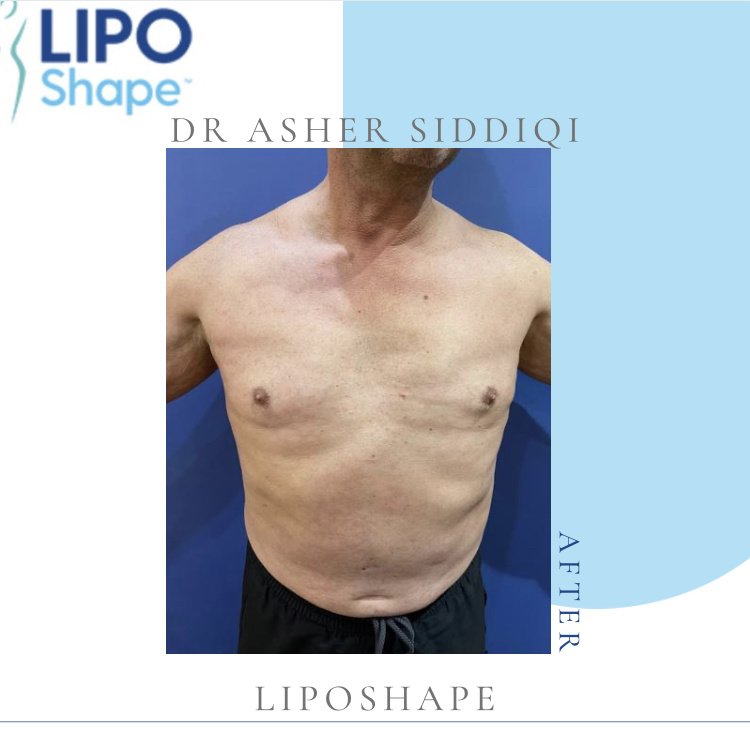 LipoShape - LipoShape
