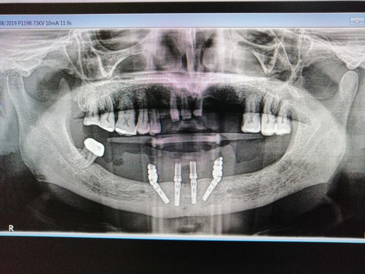 Live Implants Nicaragua - Live Implants Nicaragua