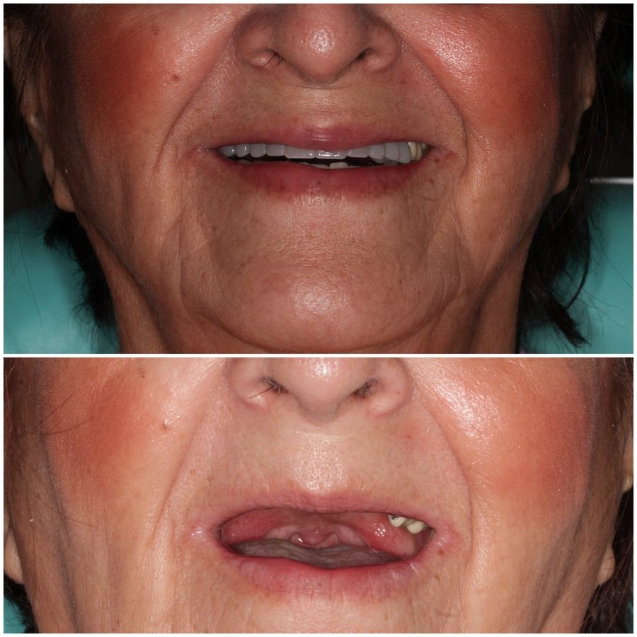 Live Implants Nicaragua - Live Implants Nicaragua