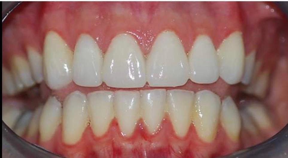 Live Implants Nicaragua - Live Implants Nicaragua