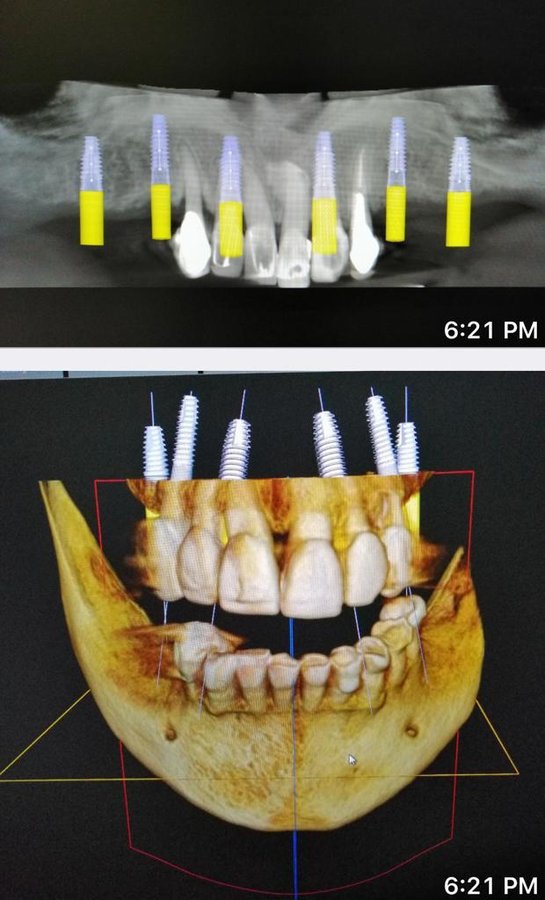 Live Implants Nicaragua - Live Implants Nicaragua