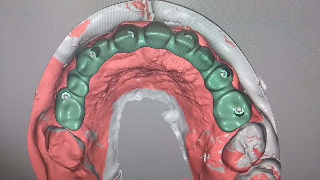 Live Implants Nicaragua - Live Implants Nicaragua