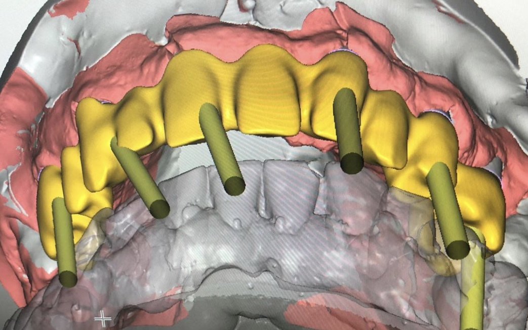 Live Implants Nicaragua - Live Implants Nicaragua