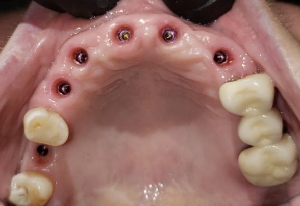 Live Implants Nicaragua - Live Implants Nicaragua